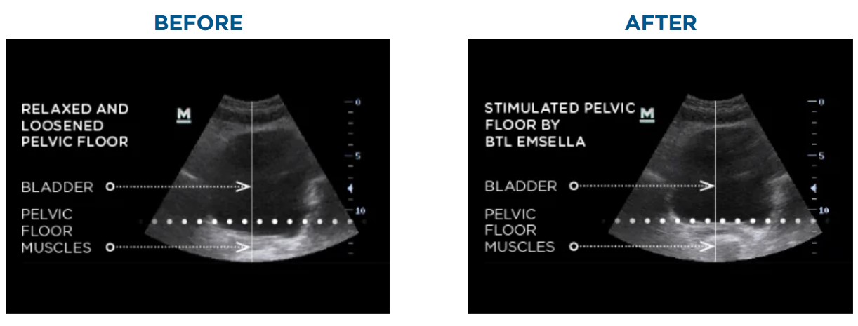 Before & After Emsella Treatment at Regenesis Life Med Spa in South Pasadena Florida