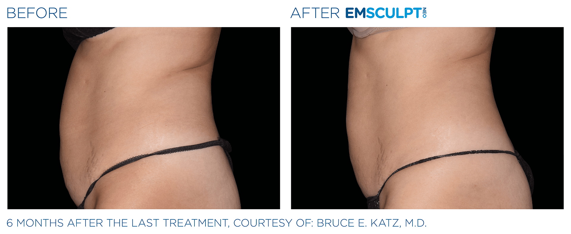 Body Contour & EMS Sculpt ST PETE - Medical Weight Loss