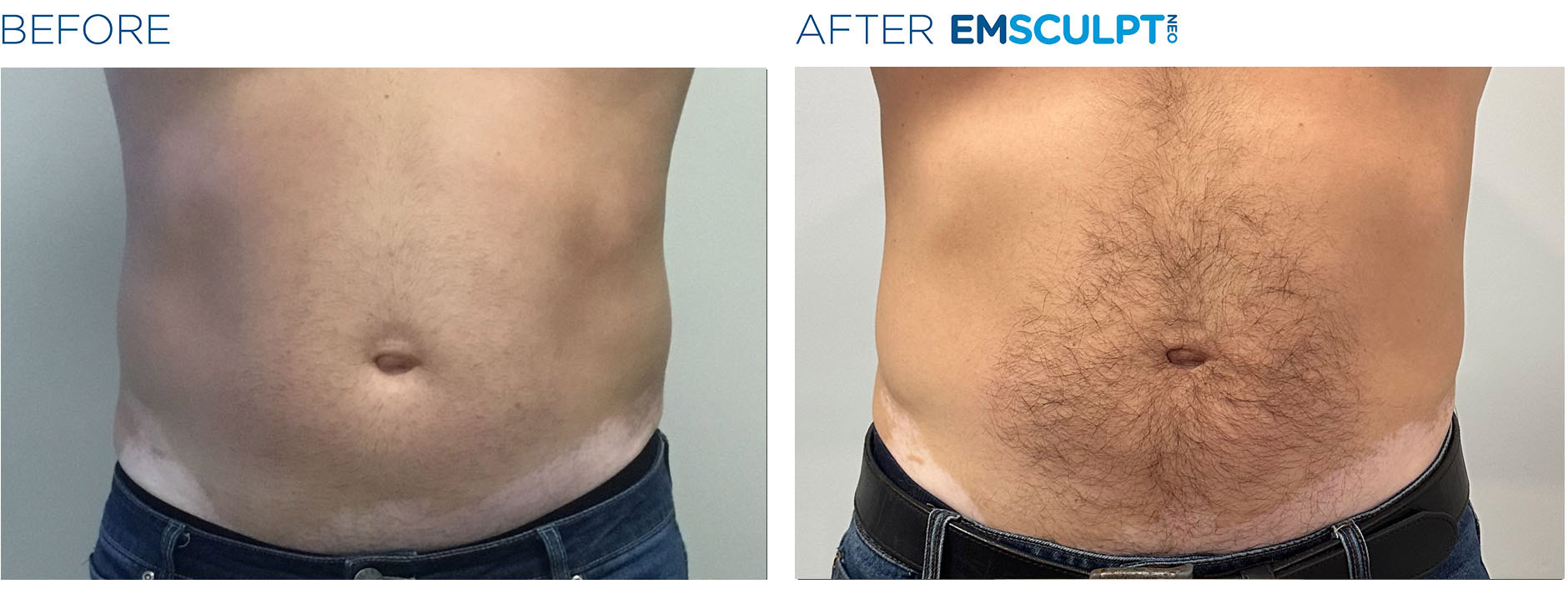 Emsculpt Before & After Transformation 