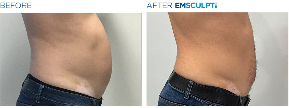 Emsculpt Neo treatment patient - Regenesis Med Spa - St Pete Florida