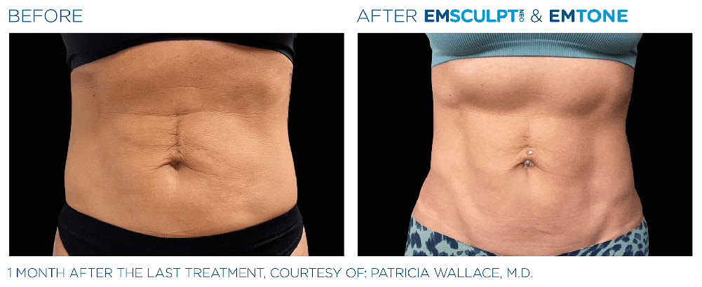 Emsculpt Neo treatment patient  - Regenesis Med Spa - South Pasadena Florida