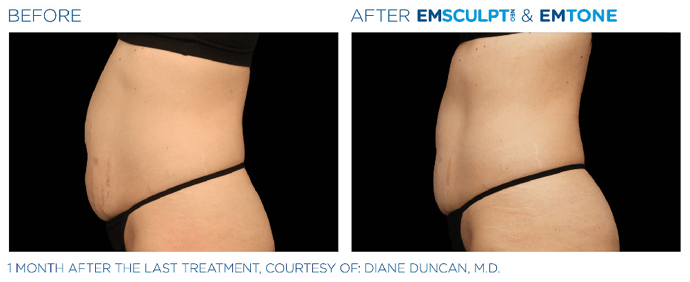 Emsculpt Neo treatment patient - Regenesis Med Spa - St Pete Florida