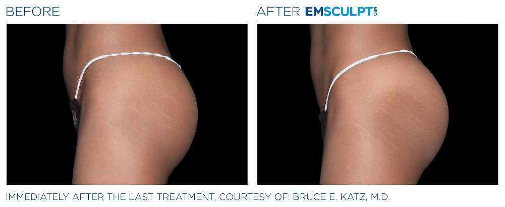 Emsculpt Neo treatment patient  - Regenesis Med Spa - South Pasadena Florida