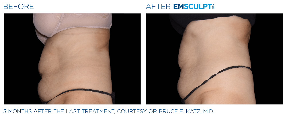 Emsculpt Neo treatment patient - Regenesis Med Spa - St Pete Florida