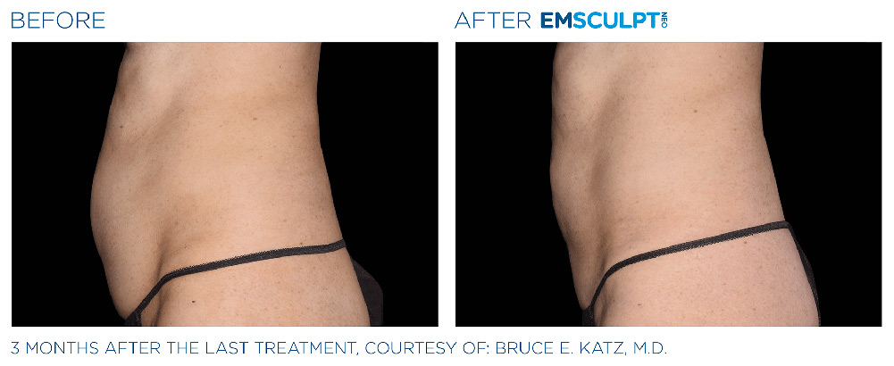 Emsculpt Neo treatment patient - Regenesis Med Spa - South Pasadena Florida