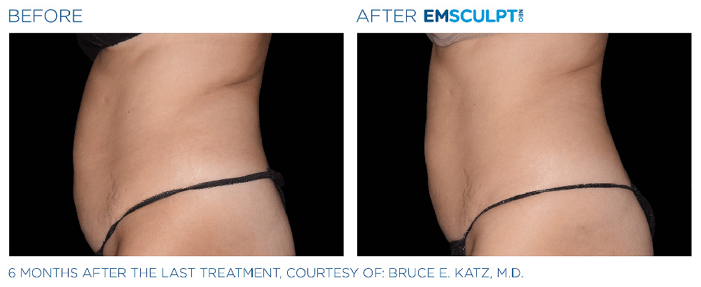 Emsculpt Neo treatment patient - Regenesis Med Spa - South Pasadena Florida