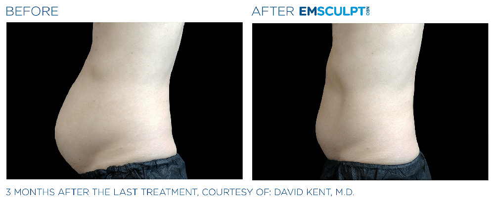 Emsculpt Neo treatment patient - Regenesis Med Spa - South Pasadena Florida