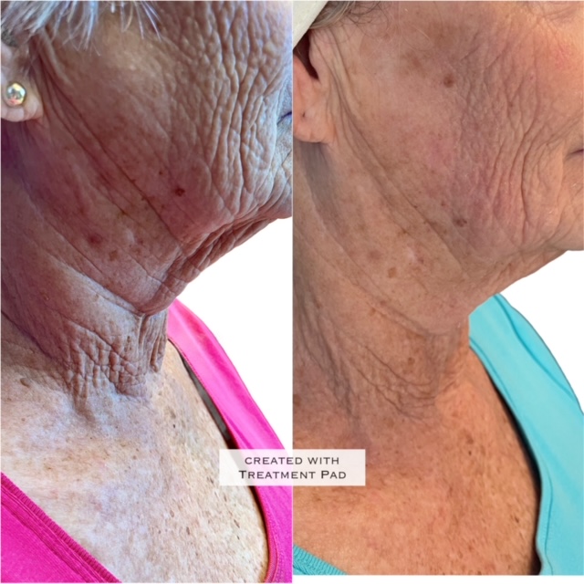 Emsculpt Neo treatment patient - Regenesis Med Spa - St Pete Florida